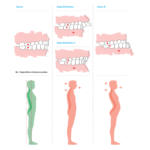 rapporto-occlusione-postura
