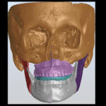 CAD CAM splint chirurgico finale
