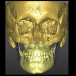 T1: pre op. VSP virtual surgical planning - chirurgia bimascellare