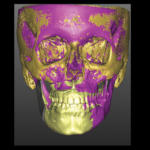Superimposizione 3D Base Cranica VSP/FINALE (T2)