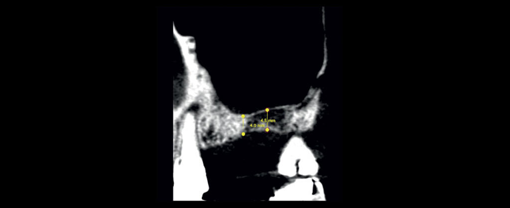 Misurazione dell’altezza ossea residua misurata su CBCT