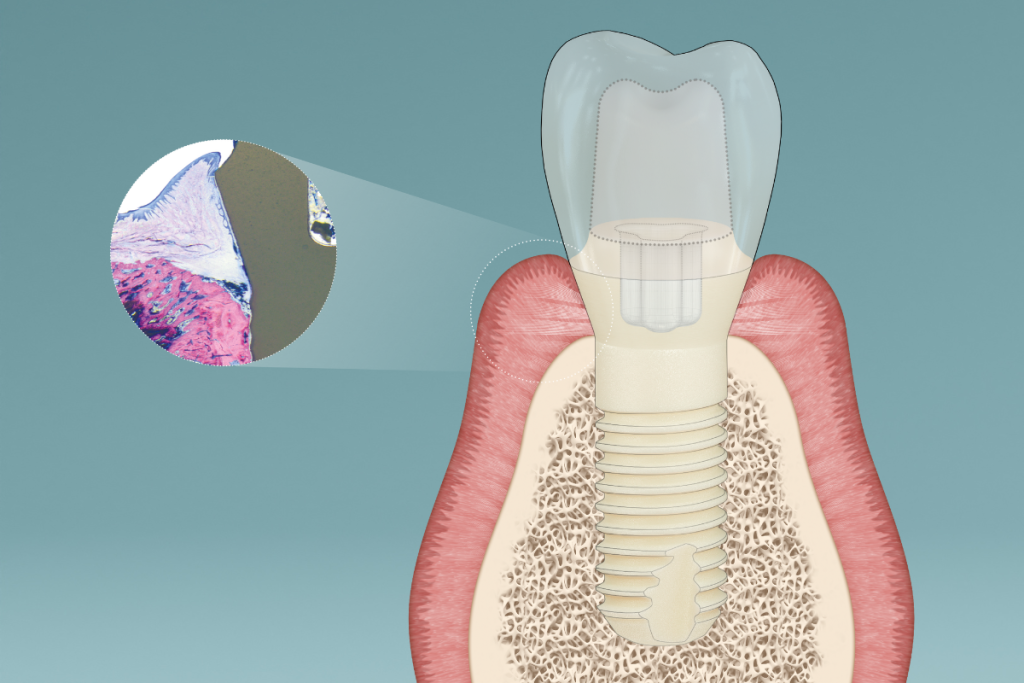 Perimplantite