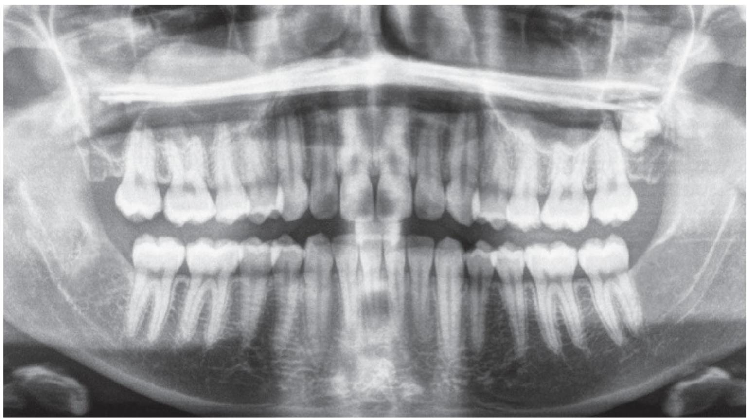 Forcipe Dentale Estrazione Terzo Molare Inferiore - Fig 18 - Medspo