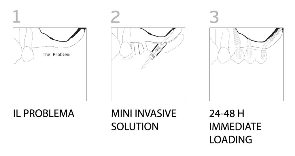 NSI 3D IMPLANT