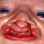 labiopalatoschisi_01