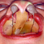 labiopalatoschisi_02