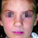 labiopalatoschisi_03