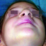 labiopalatoschisi_04