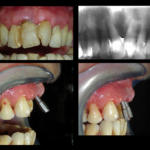 Fig. 7 Quarto caso clinico. I denti frontali in fase espulsiva, la loro estrazione, l’inserimento angolato degli impianti e la piegatura di parallelizzazione.