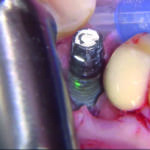 Fig. 9 Azione del laser sulle spire.