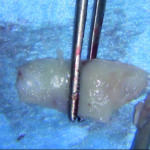 Fig. 10 Innesto di tessuto connettivo prelevato dal palato.