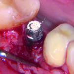 Fig. 5 Presenza di tessuto di granulazione attorno alla fixture.