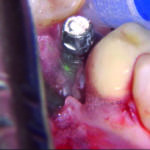 Fig. 6 Rimozione del tessuto di granulazione con laser Er-Yag.