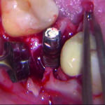 Fig. 7 Superficie implantare esposta.