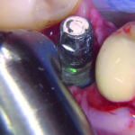 Fig. 8 Applicazione di laser Er-Yag sulla superficie.