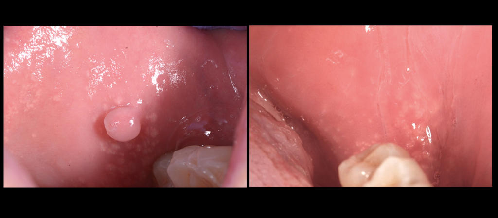 fibroma