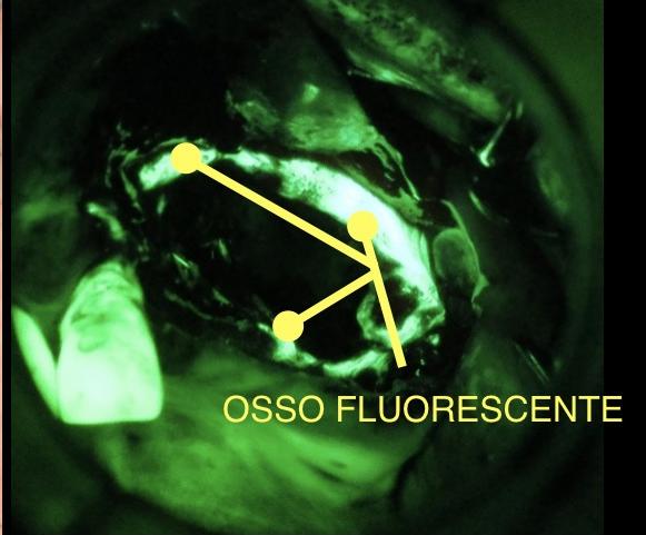 Fig. 10b Vaporizzazione mediante laser Er:YAG con eliminazione progressiva, in maniera mininvasiva, di osso ipofluerescente. Fig. 10b Vaporizzazione mediante laser Er:YAG con eliminazione progressiva, in maniera mininvasiva, di osso ipofluerescente.
