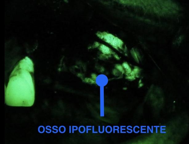 Fig. 8b Osteonecrosi mascellare in visione clinica diretta e in AF (autofluorescenza). Fig. 8b Osteonecrosi mascellare in visione clinica diretta e in AF (autofluorescenza).