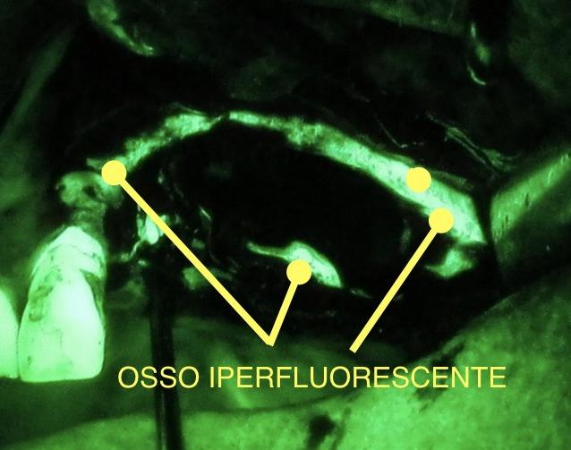 Fig. 9b Osteotomia estesa fino ad osso clinicamente sano. Fig. 9b Osteotomia estesa fino ad osso clinicamente sano.