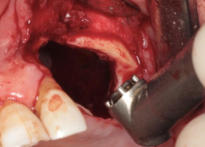 Fig. 9a Osteotomia estesa fino ad osso clinicamente sano. Fig. 9a Osteotomia estesa fino ad osso clinicamente sano.