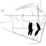 Fig. 16b Tracciato cefalometrico.