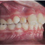 Fig. 6e Disgiuntore del secondo paziente.