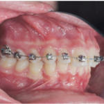 Fig. 7e Fase iniziale del trattamento ortodontico fisso del primo paziente.