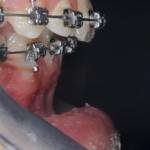 Fig. 10b Fase finale del trattamento ortodontico fisso del secondo paziente.
