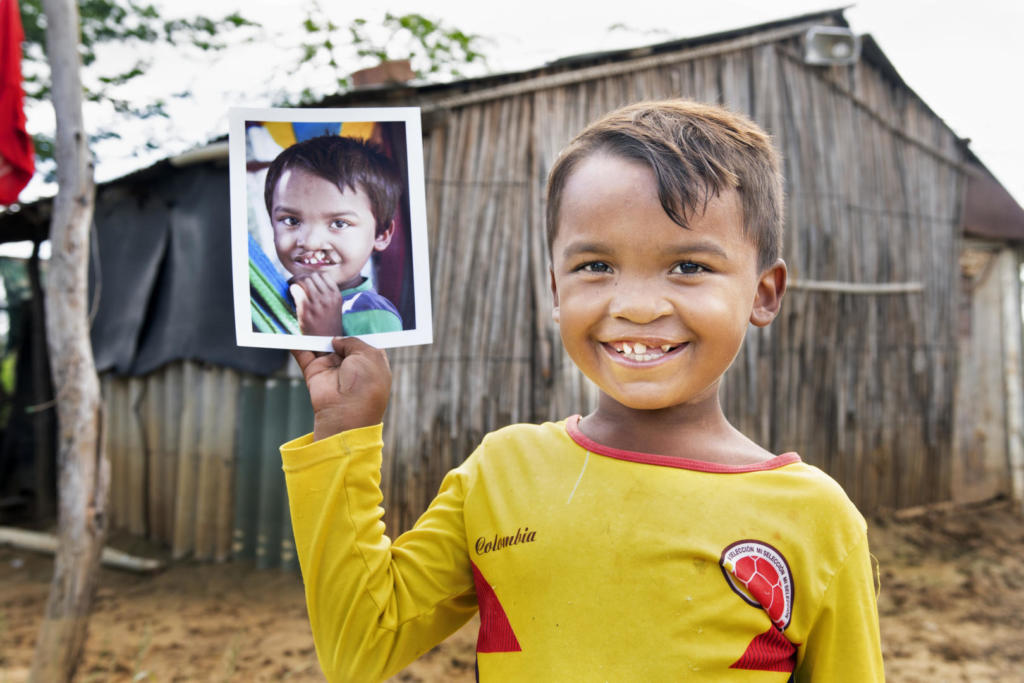 Il piccolo Pedro è uno dei pazienti curati grazie ai programmi medici di Operation Smile. Dal Venezuela è arrivato con la sua famiglia in Colombia, dove ha ritrovato la speranza in un futuro migliore. A Riohacha, grazie a un programma chirurgico di Operation Smile, ha ritrovato il suo nuovo sorriso.
