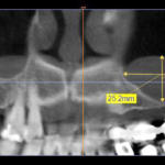 Fig. 1a CBCT del secondo quadrante in cui è possibile osservare la posizione e la dimensione della patologia sinusale: visione frontale.