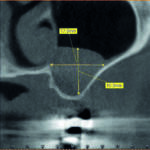 Fig. 1b CBCT del secondo quadrante in cui è possibile osservare la posizione e la dimensione della patologia sinusale: visione sagittale.