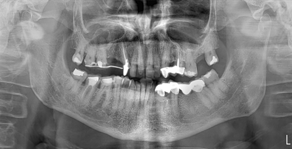 Fig. 3 Ortopantomografia (OPT) preoperatoria.