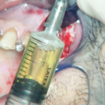 Fig. 6 Contenuto della lesione; da notare il tipico colore giallo-paglierino.