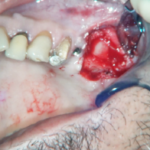 Fig. 8 Riposizionamento dello sportello osseo nella sua sede.