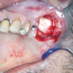 Fig. 9 Posizionamento di membrana in collagene a protezione dello sportello osseo.