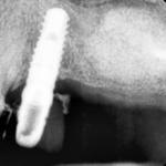 Fig. 10 Controllo radiografico a 4 mesi dall’intervento.