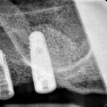 Fig. 11 Radiografia endorale di controllo: impianto Winsix Biosafin 4.5 x 11.