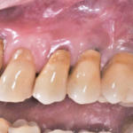 Fig. 12 A quattro mesi dall’inserimento dell’impianto viene consegnato il definitivo.