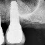 Fig. 13 A un anno dal carico dell’impianto.