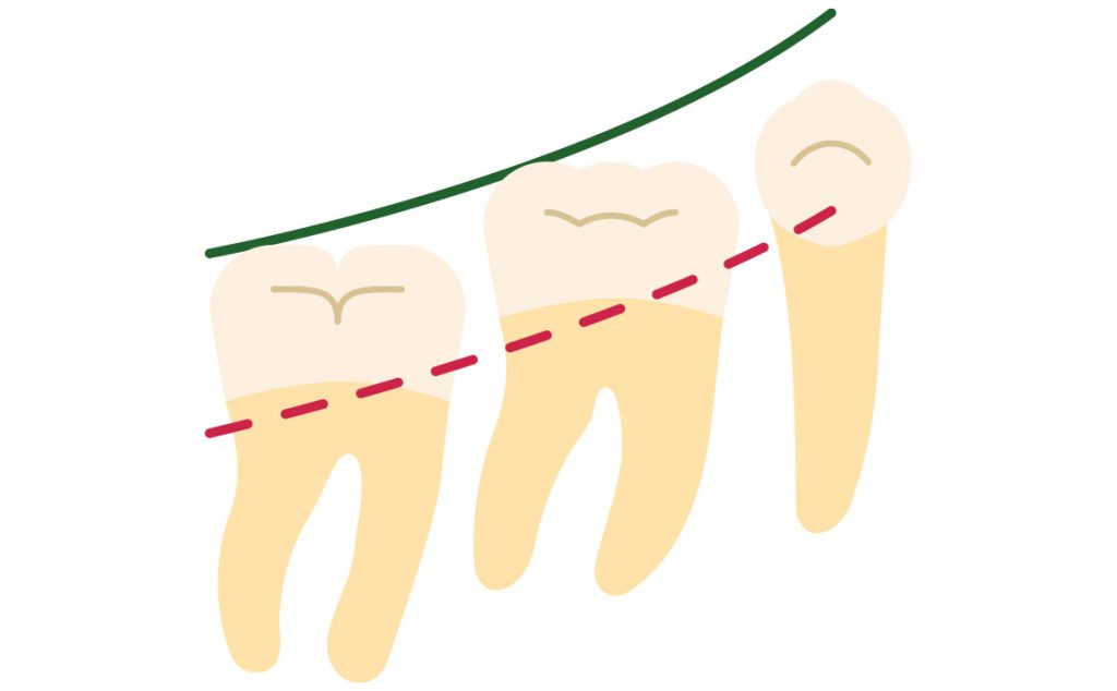Fig. 1A Type I PFE.