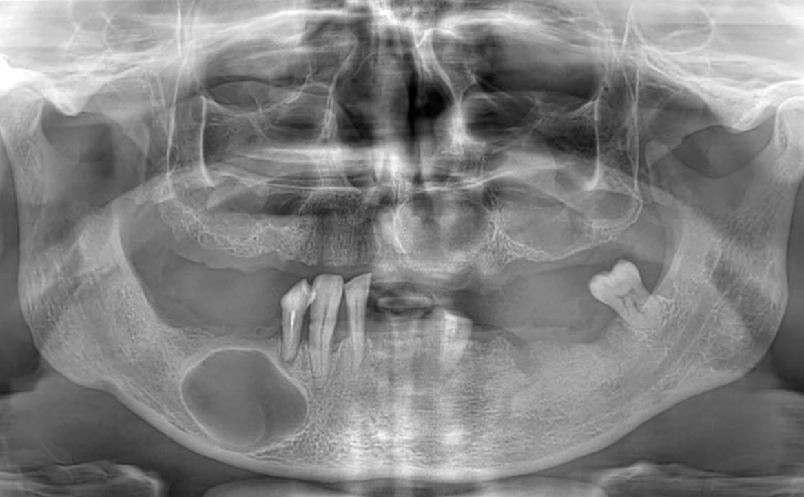 Fig. 2 Ortopantomografia (OPT) pre-operatoria.