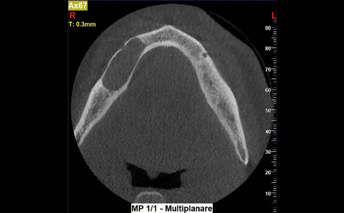 Fig. 3A Tomografia computerizzata cone beam (CBCT) pre-operatoria.
