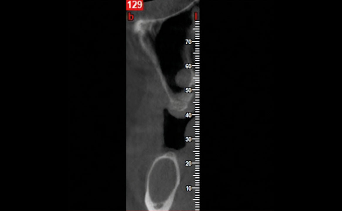 Fig. 3B Tomografia computerizzata cone beam (CBCT) pre-operatoria.
