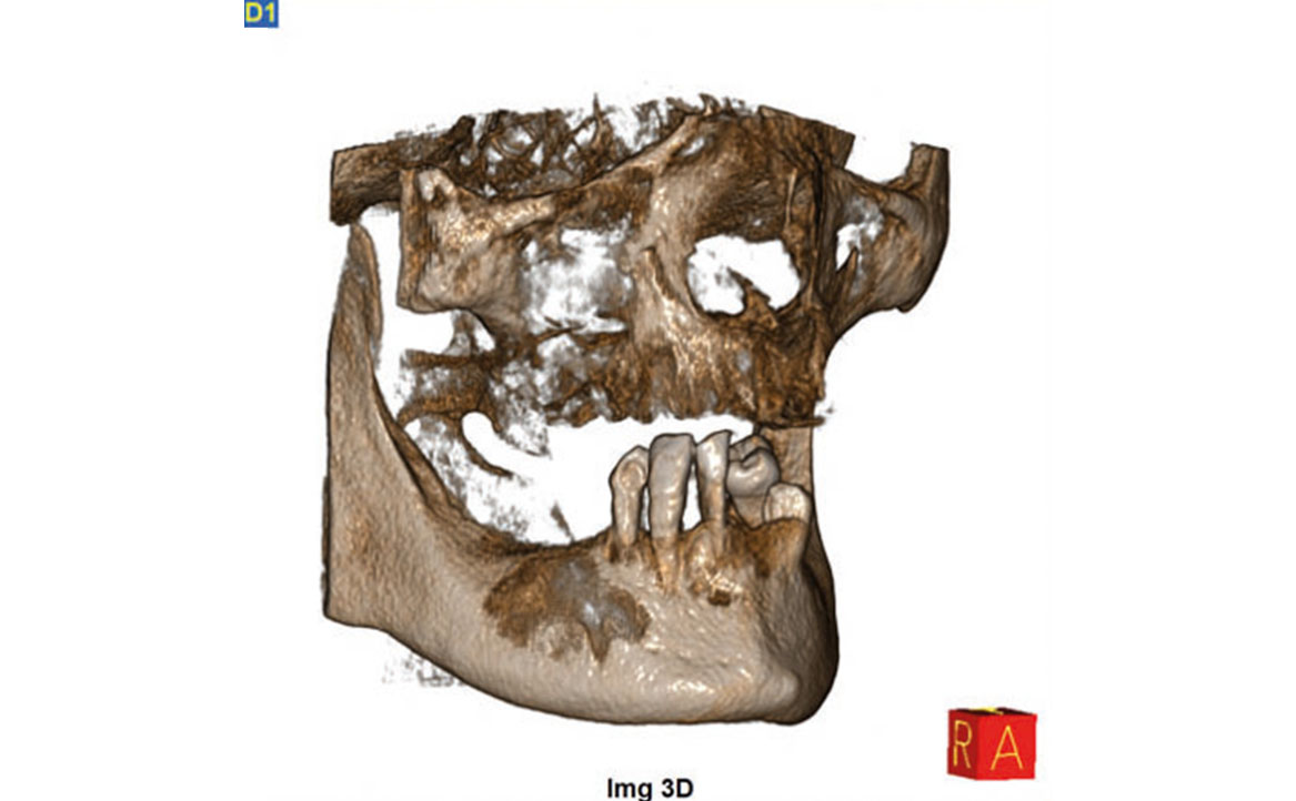 Fig. 3C Tomografia computerizzata cone beam (CBCT) pre-operatoria.