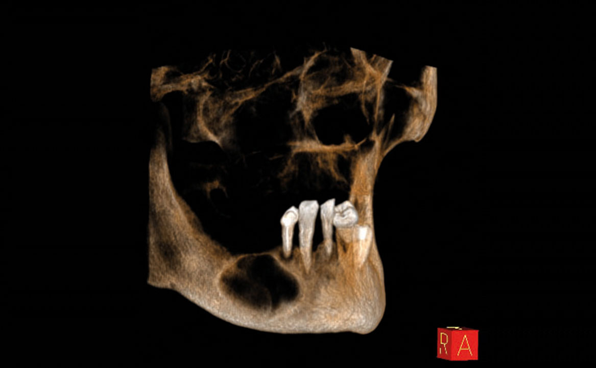 Fig. 3D Tomografia computerizzata cone beam (CBCT) pre-operatoria.