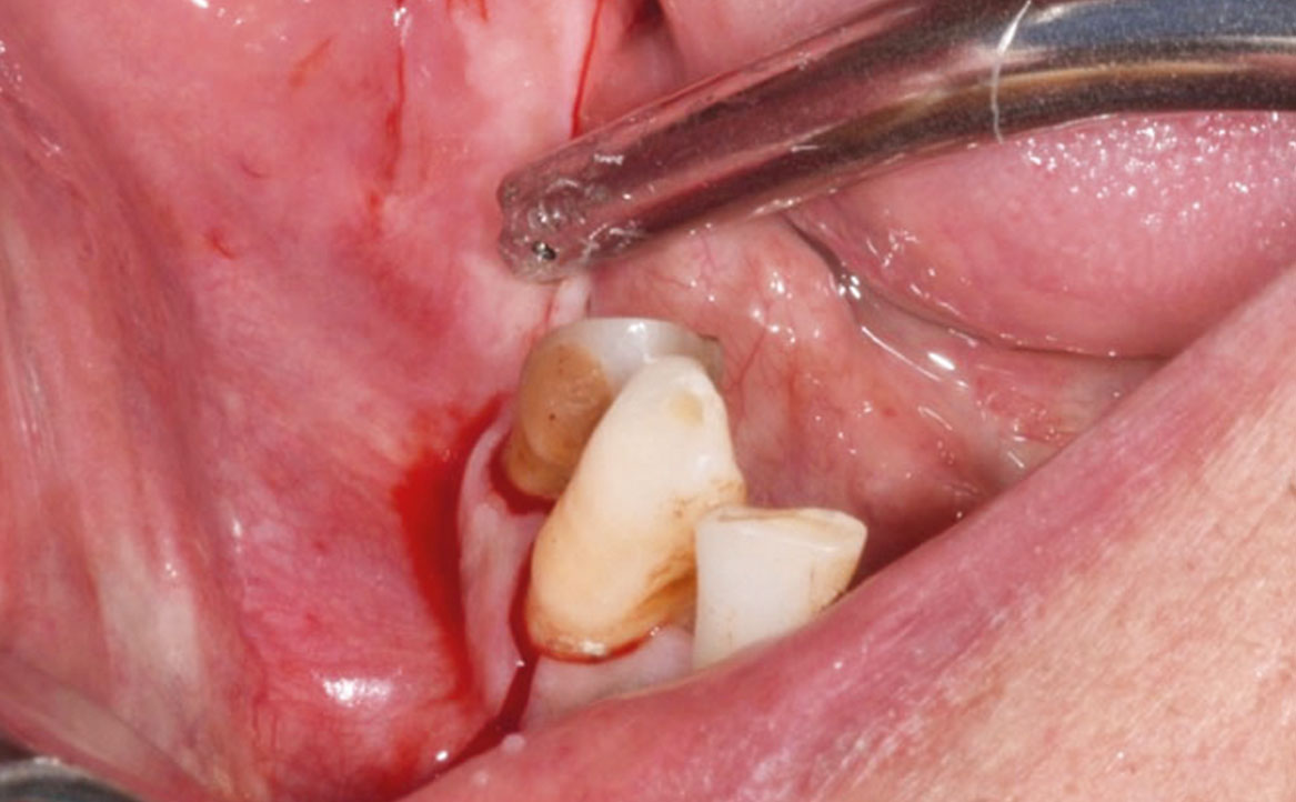 Fig. 4 Incisione crestale.