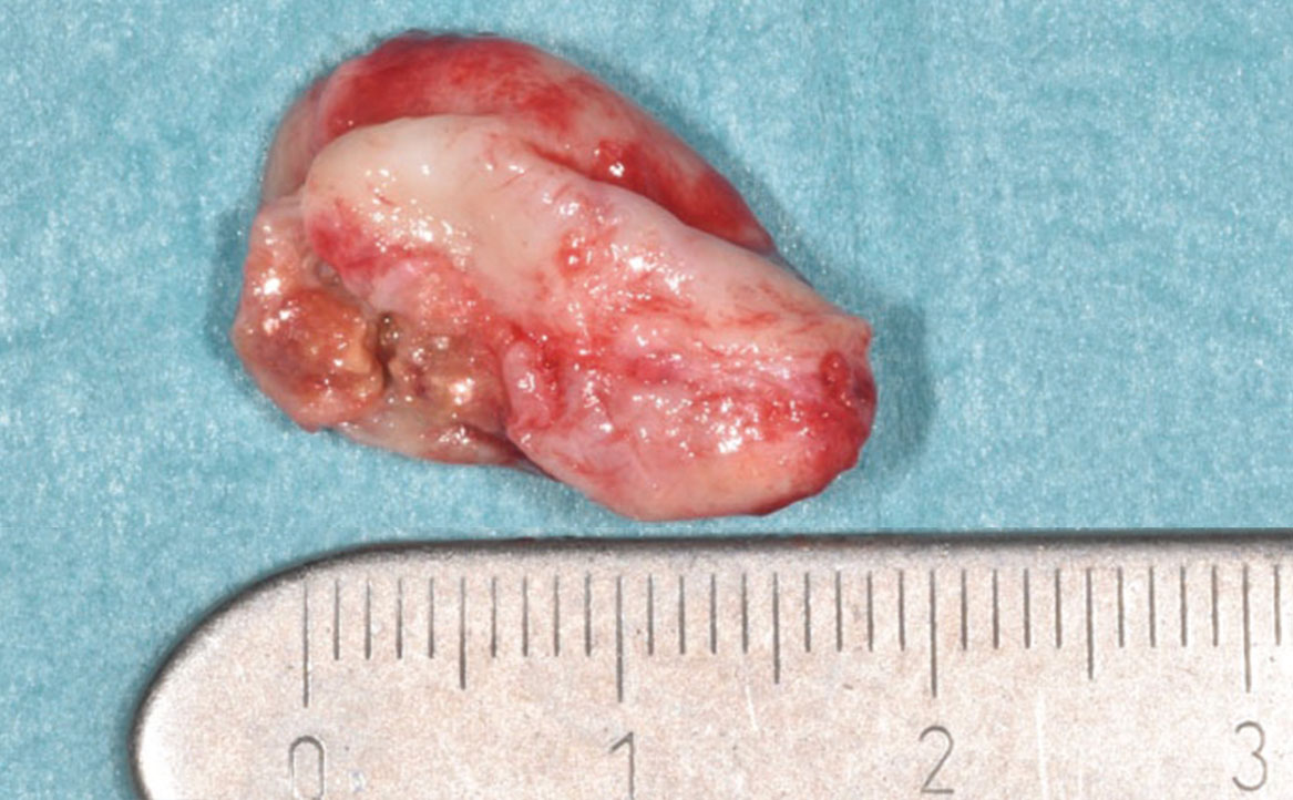 Fig. 6 Visione extra-orale della lesione.