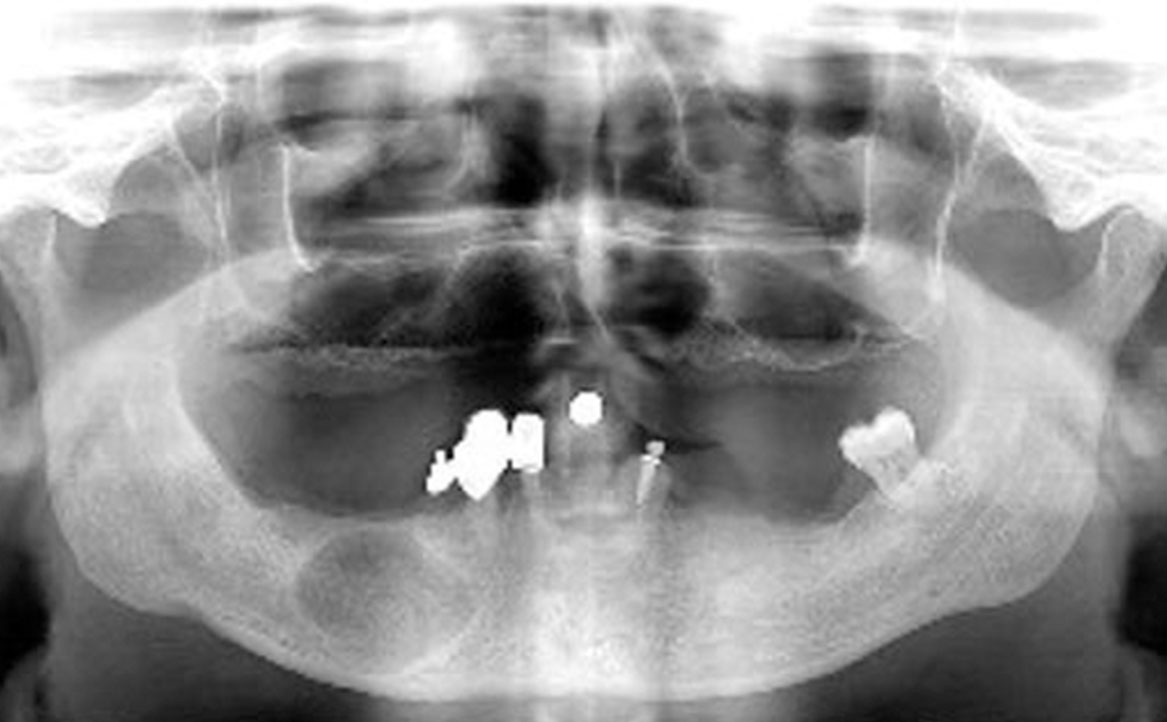 Fig. 9 Ortopantomografia (OPT) a 12 mesi dall’intervento.