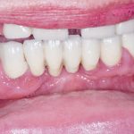 Fig. 1A Caso clinico di aumento di volume gengivale indotto dalla assunzione di nifedipina (calcio-antagonista), diffuso ad entrambe le arcate.