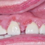 Fig. 1B Caso clinico di aumento di volume gengivale indotto dalla assunzione di nifedipina (calcio-antagonista), diffuso ad entrambe le arcate.